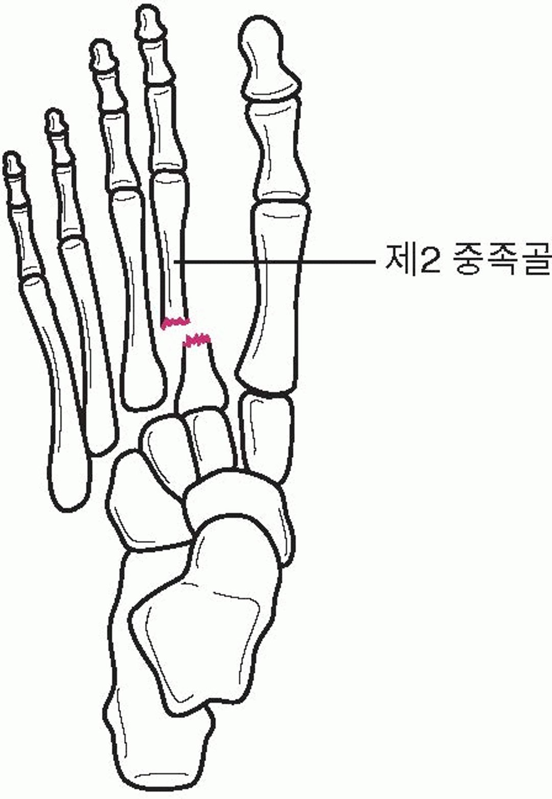 리스프랑 골절-탈구