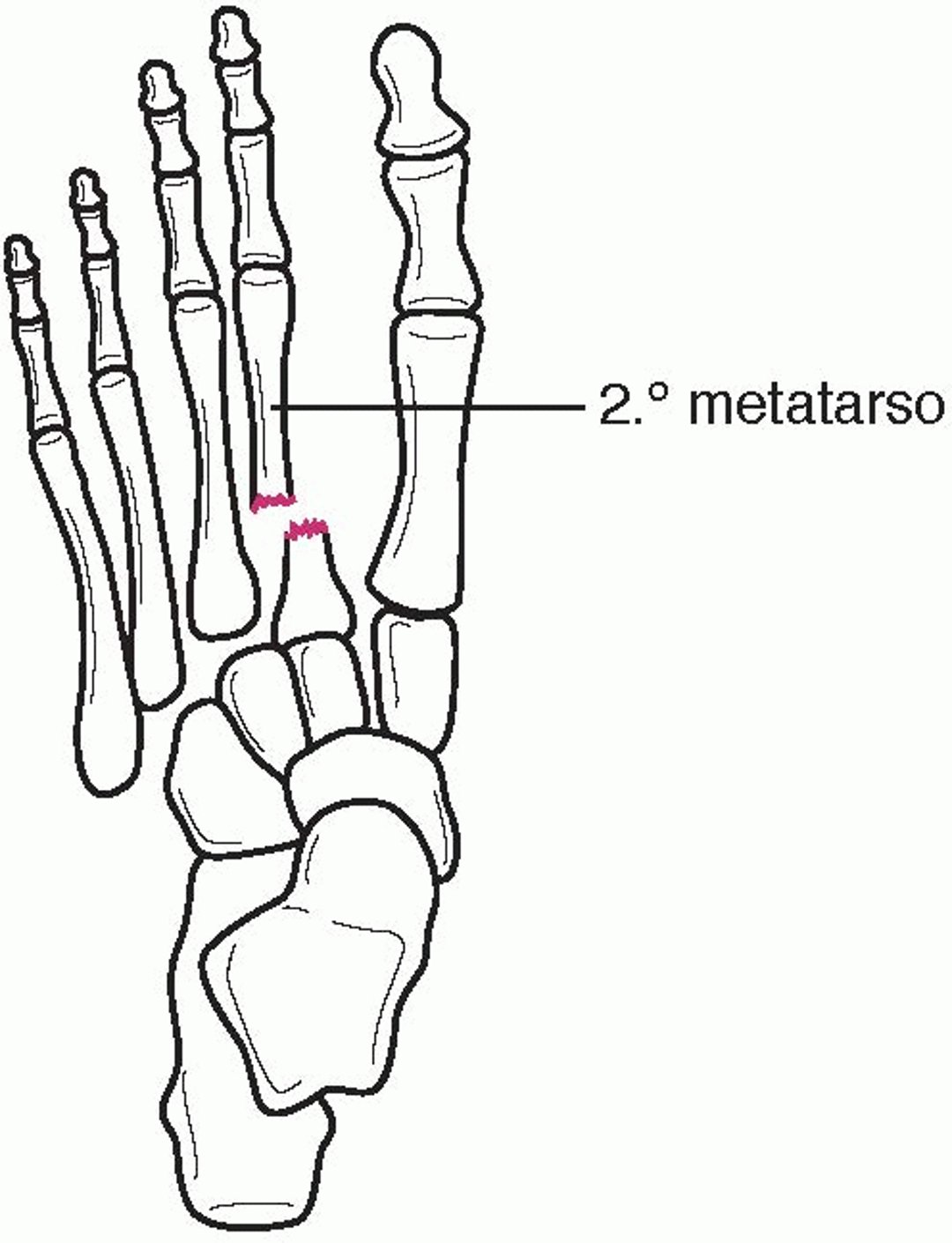 Fratura-luxação de Lisfranc