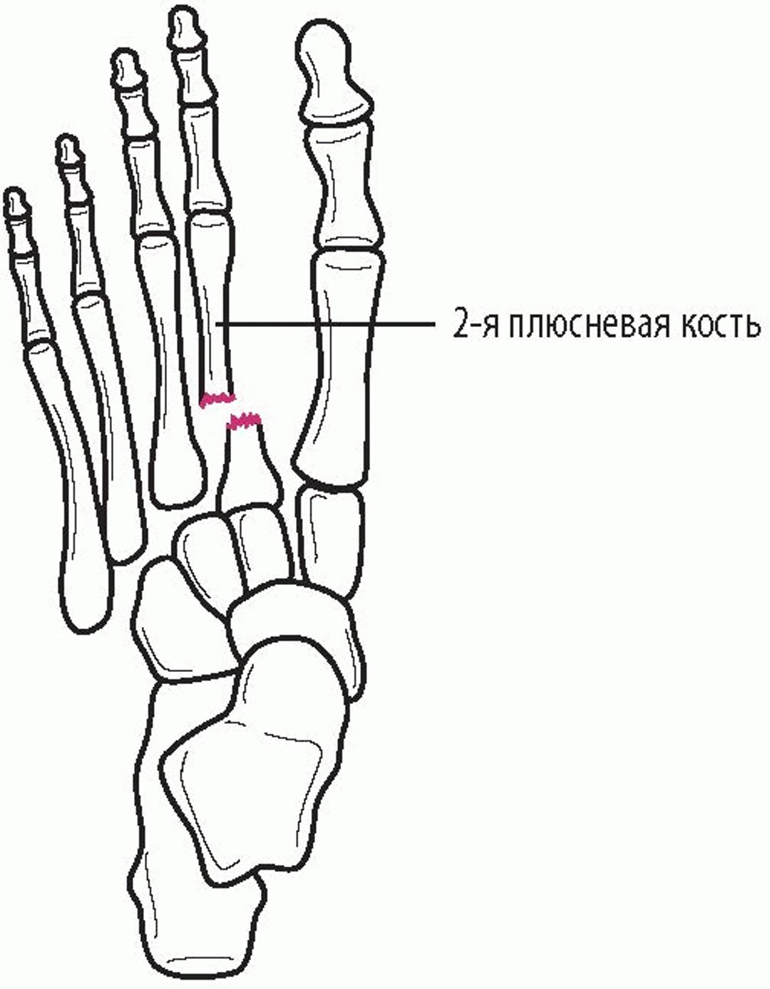 Перелом со смещением Лисфранка
