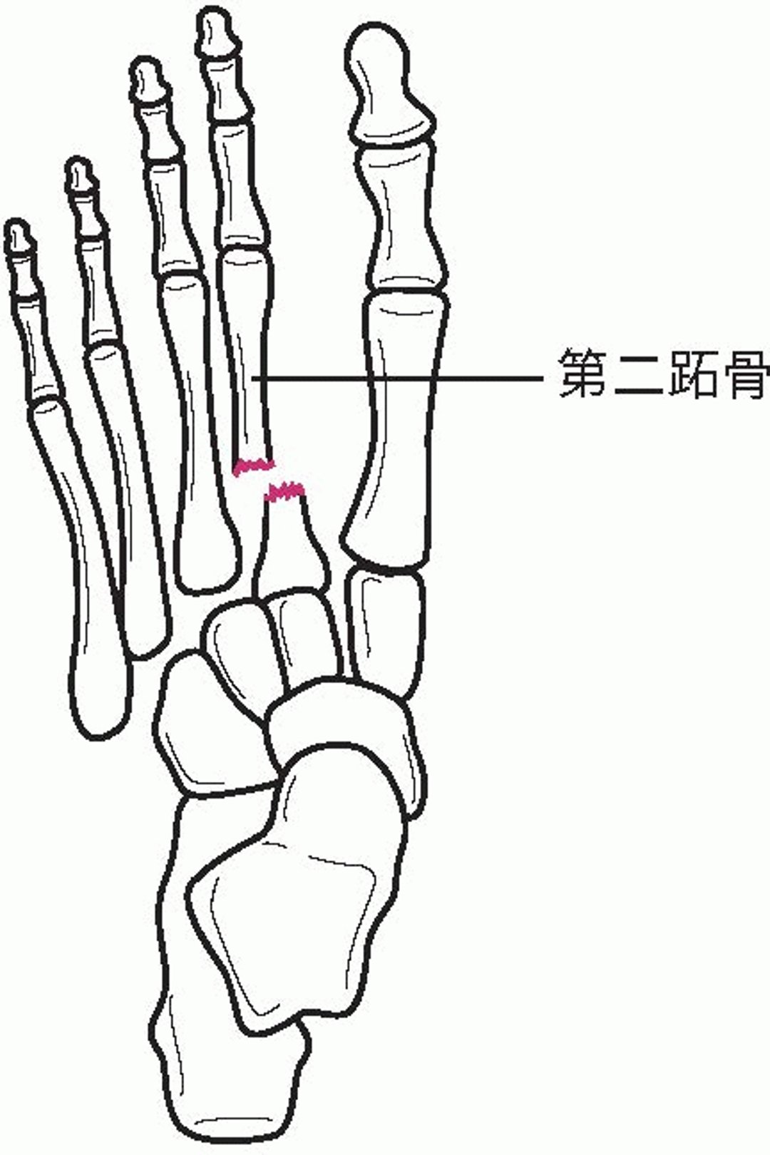 跖跗关节骨折-脱位