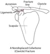 Fracturing the Collarbone