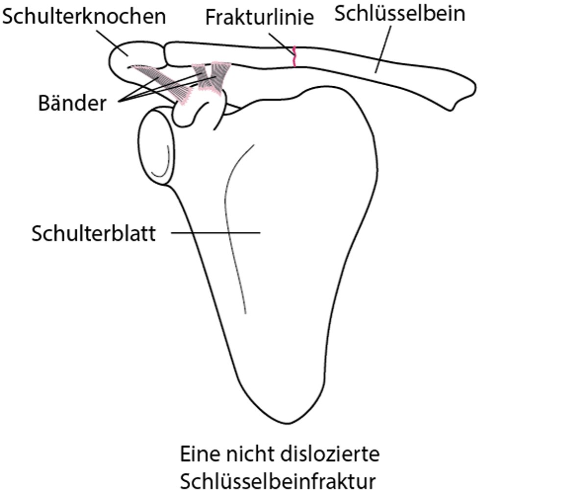 Frakturierung des Schlüsselbeins