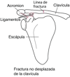 Fracturas de la clavícula