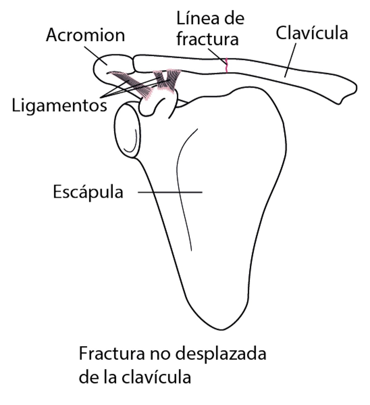 Fracturas de la clavícula