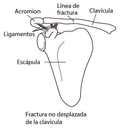 Datos clave:Clavícula rota - Manual MSD versión para público general