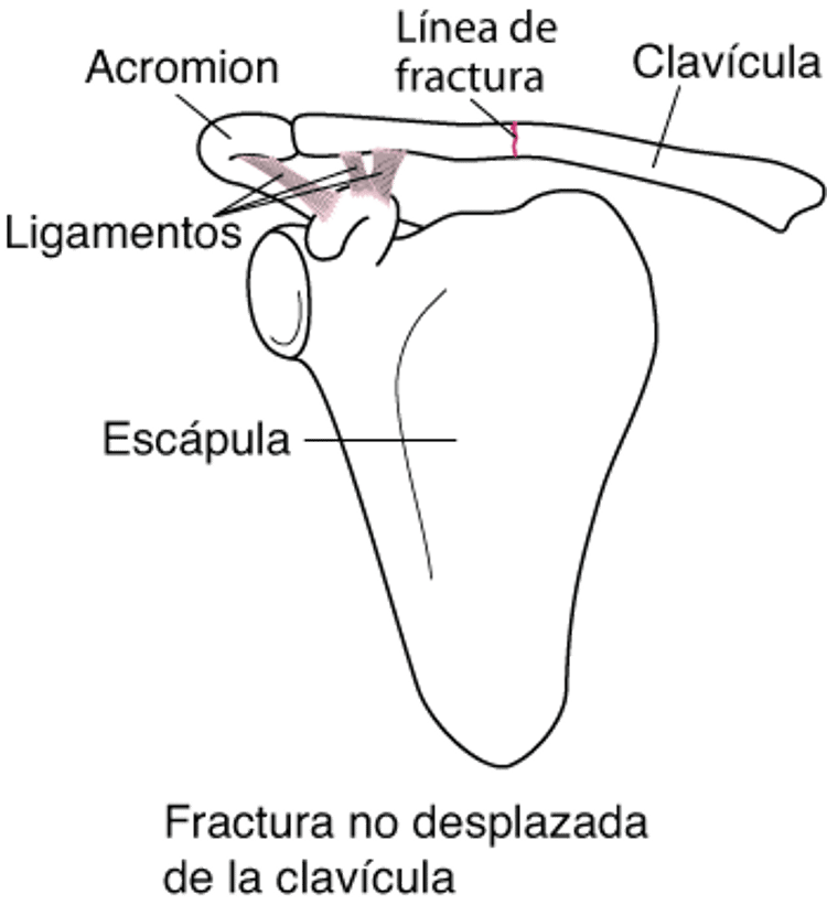 Fracturas de la clavícula