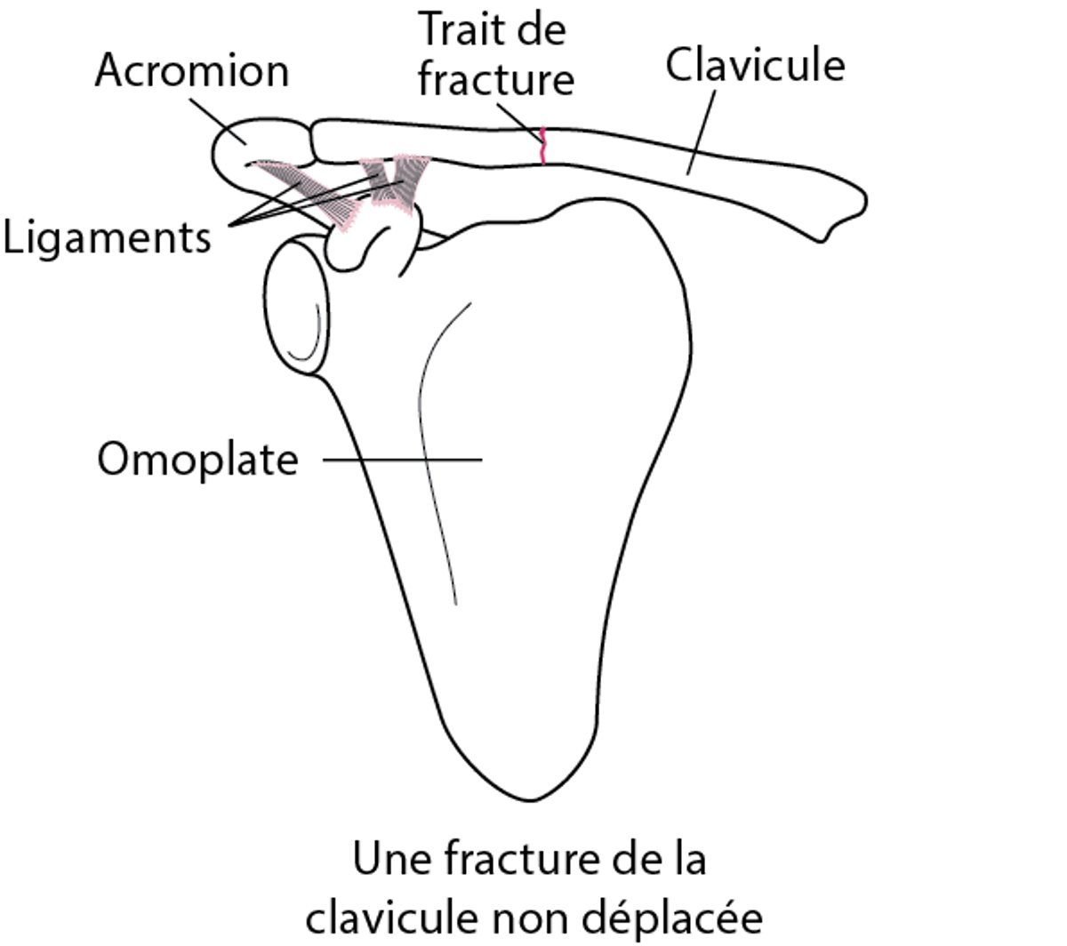 Fracture de la clavicule