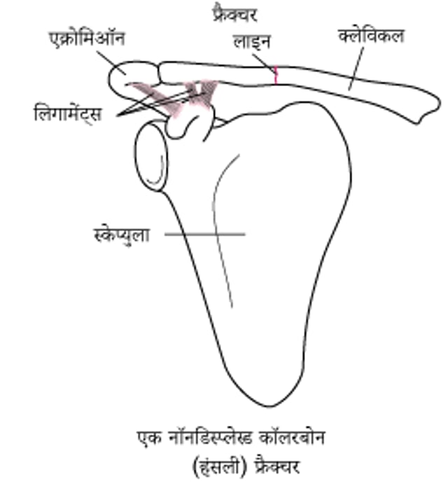 कॉलरबोन में फ्रैक्चर होना