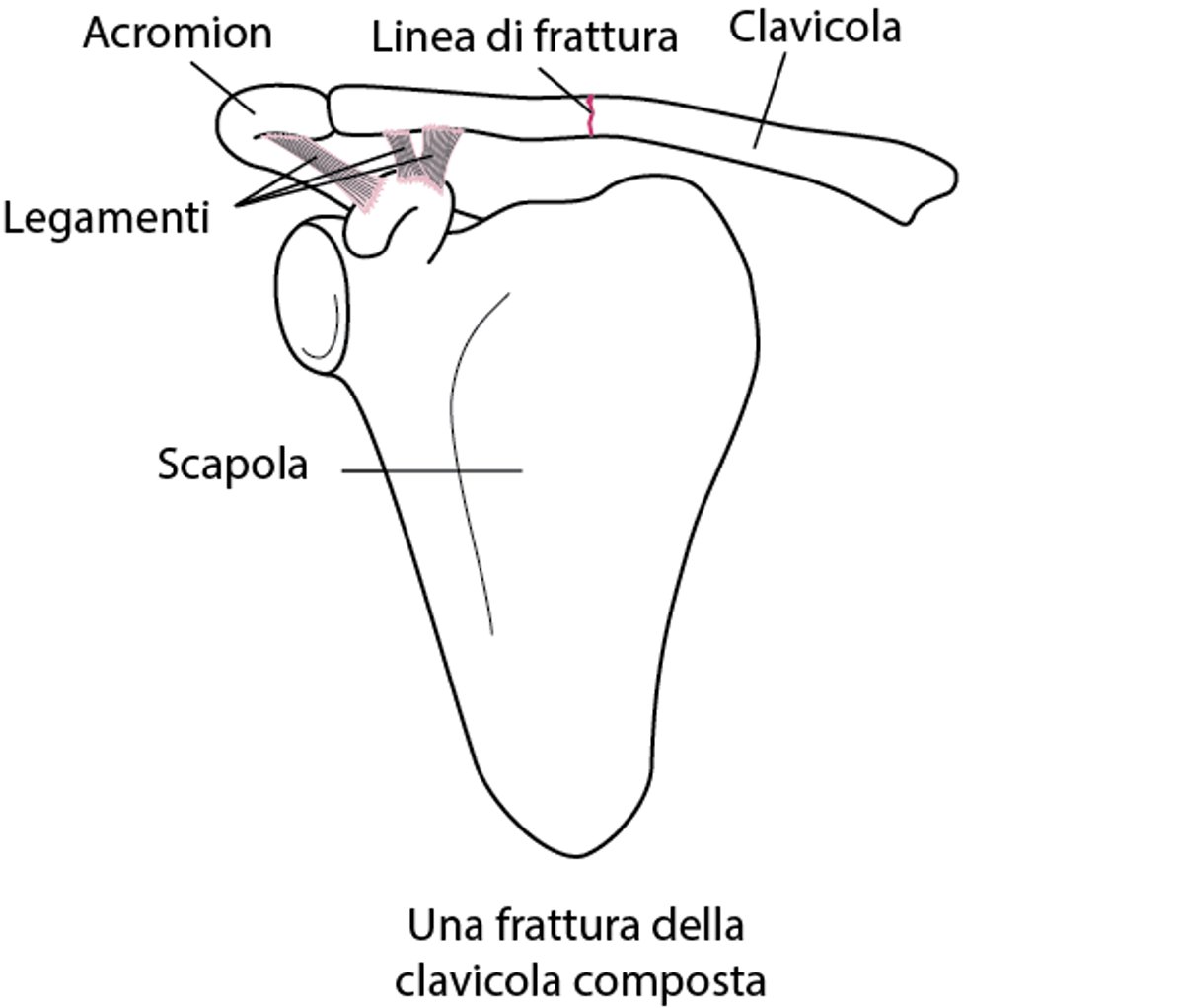Frattura della clavicola