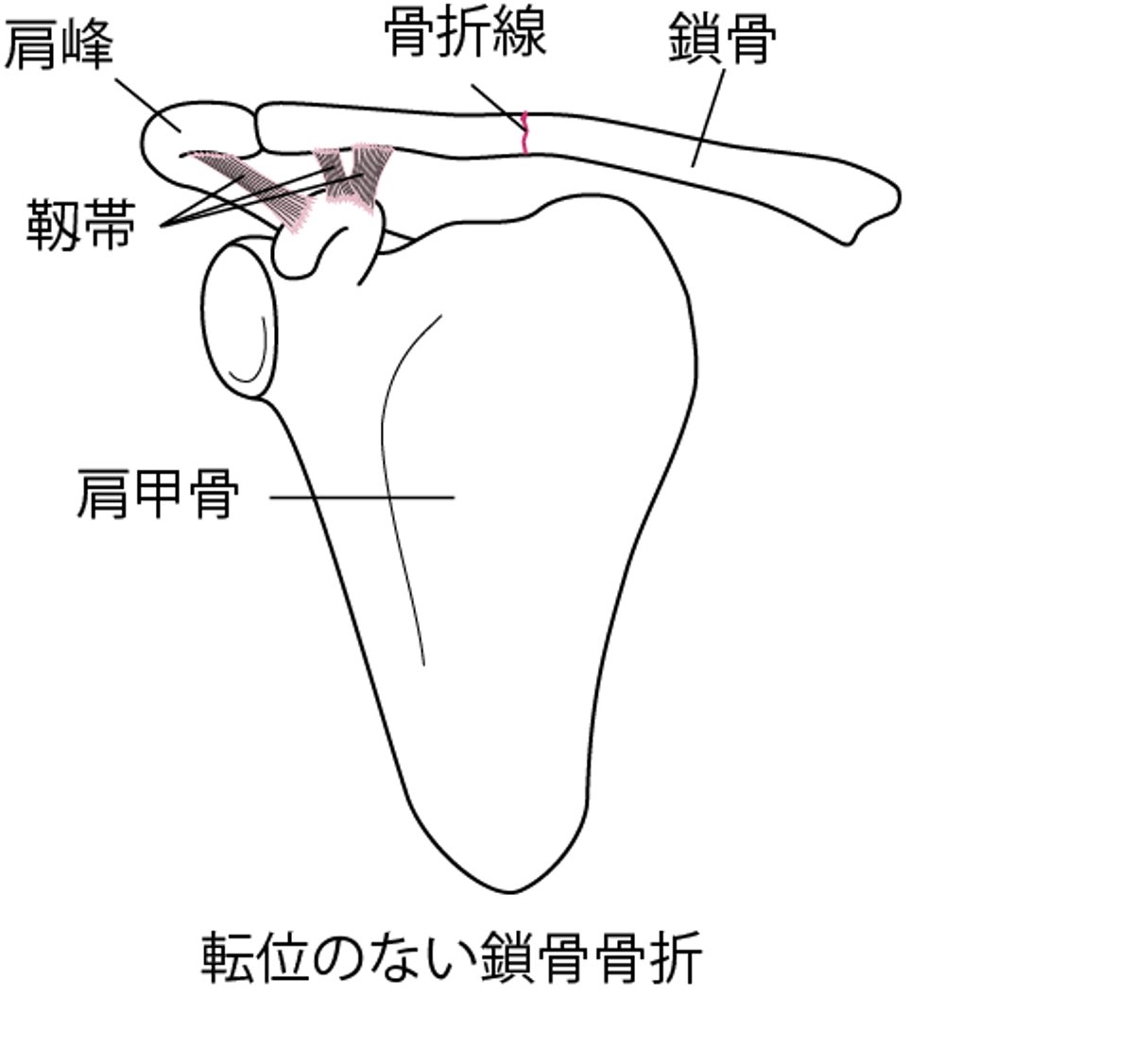 鎖骨さこつの骨折こっせつ