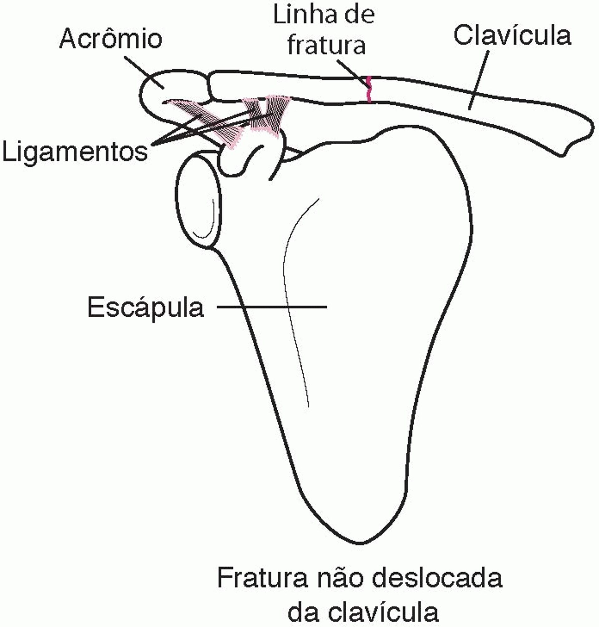 Fratura da clavícula