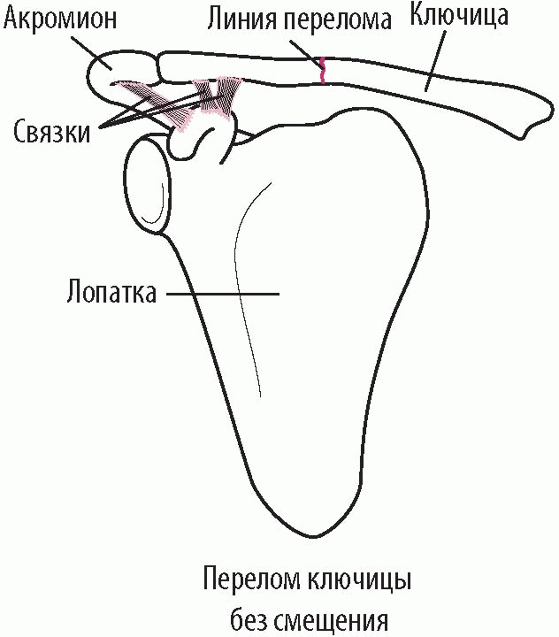 Переломы ключицы