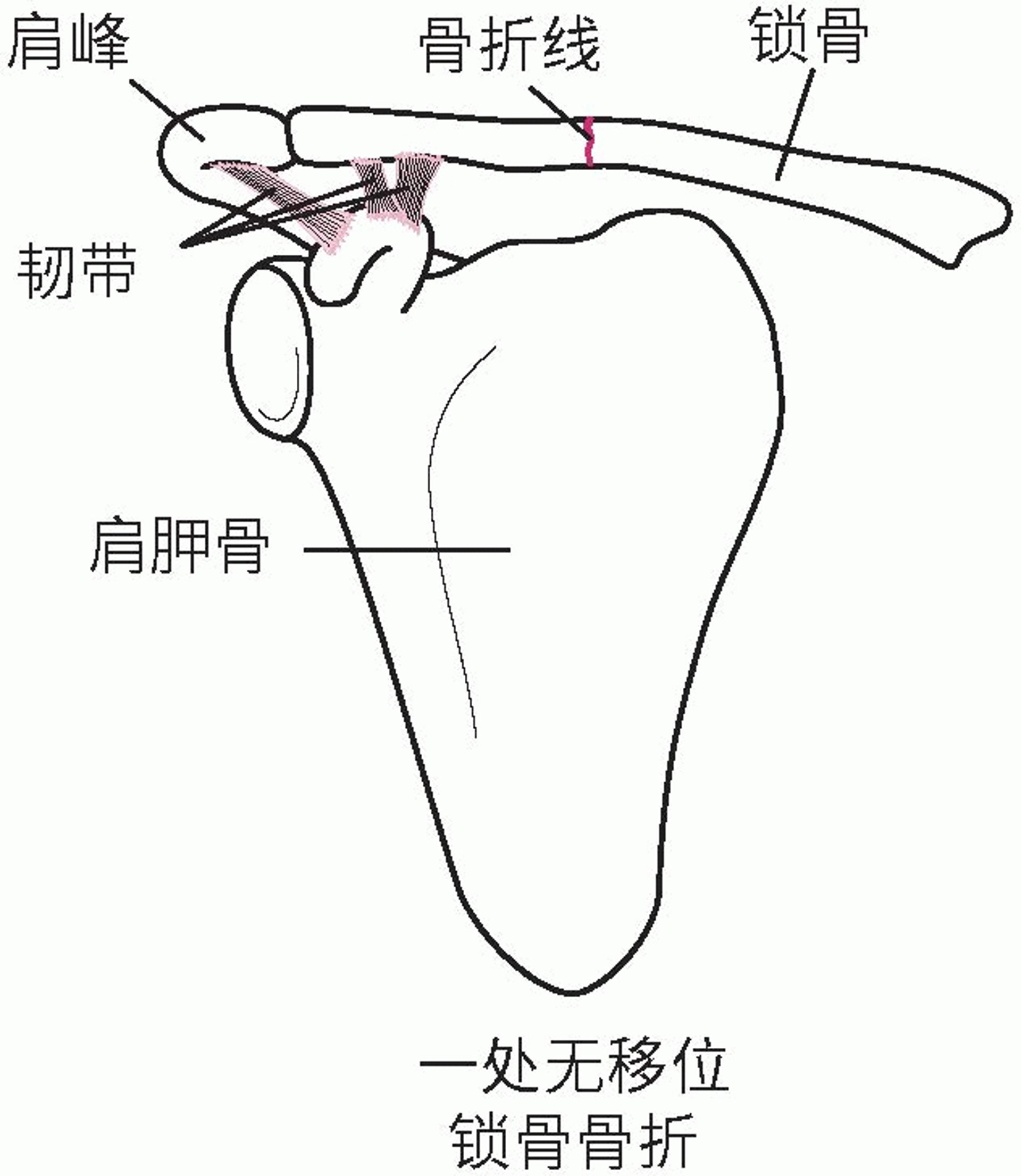 锁骨破裂