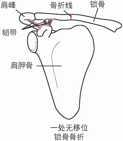 锁骨破裂