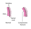 Compression Fractures of the Spine