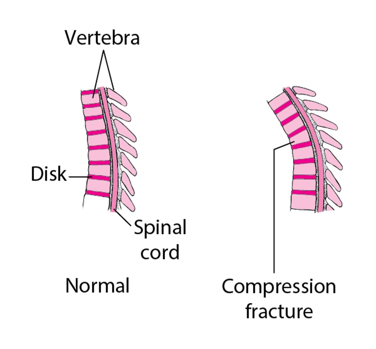 Compression Fractures of the Spine