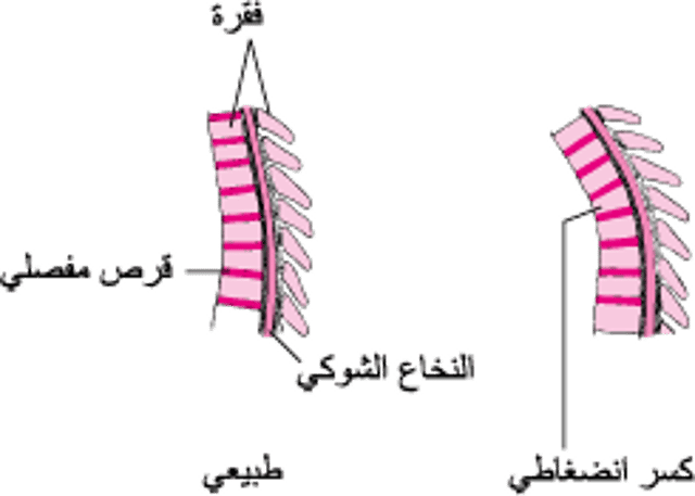 الكُسُورُ الانضِغاطية في العمود الفقري