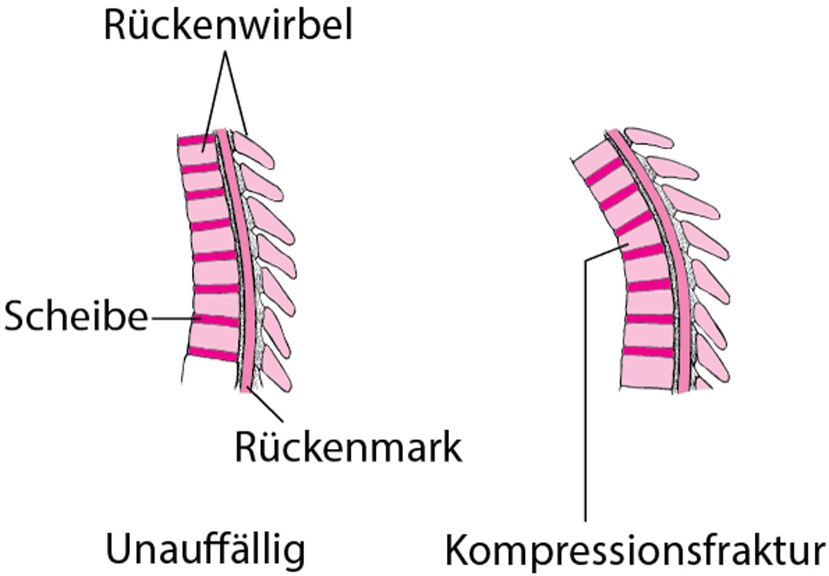 Kompressionsfrakturen der Wirbelsäule