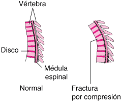 Fracturas vertebrales por compresión