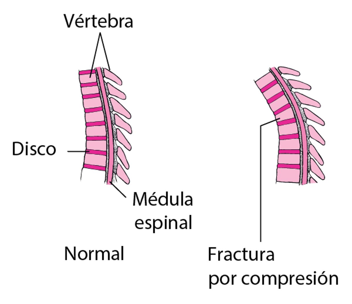 Fracturas vertebrales por compresión