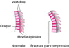 Fractures par compression de la moelle épinière