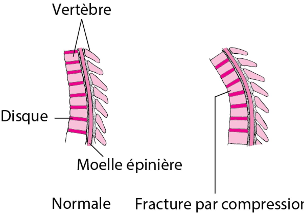 Fractures par compression de la moelle épinière
