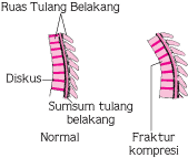 Fraktur Kompresi Tulang Belakang