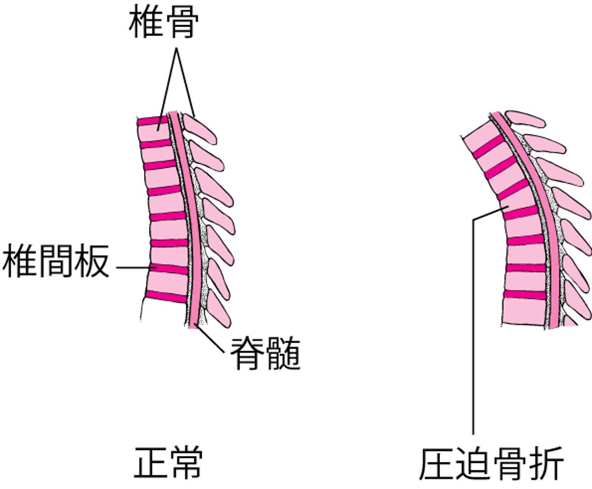 脊椎の圧迫骨折