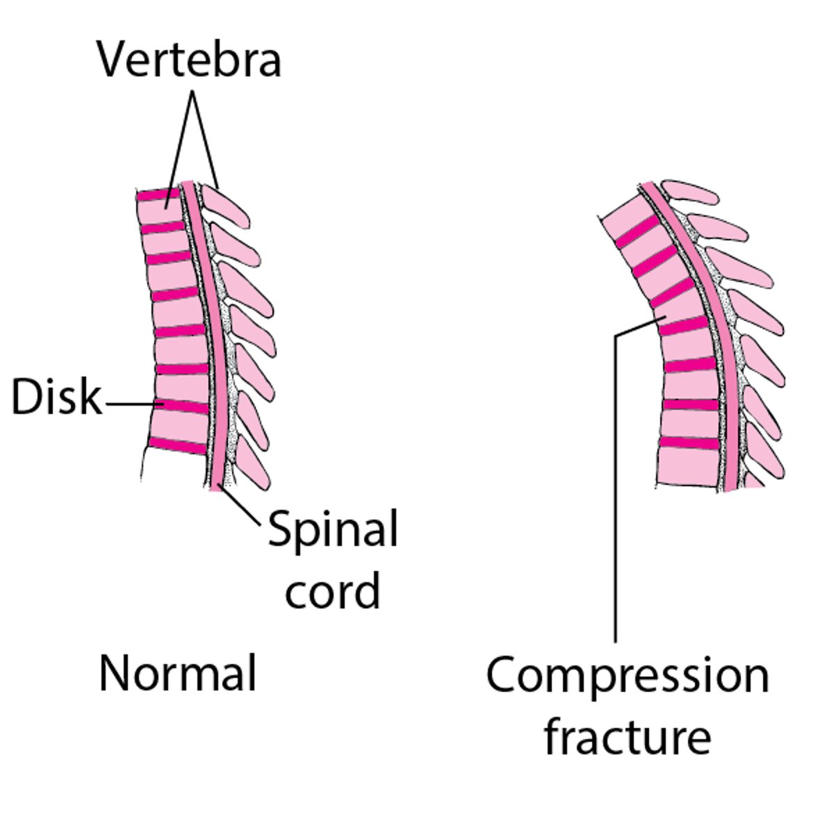 척추 압박 골절
