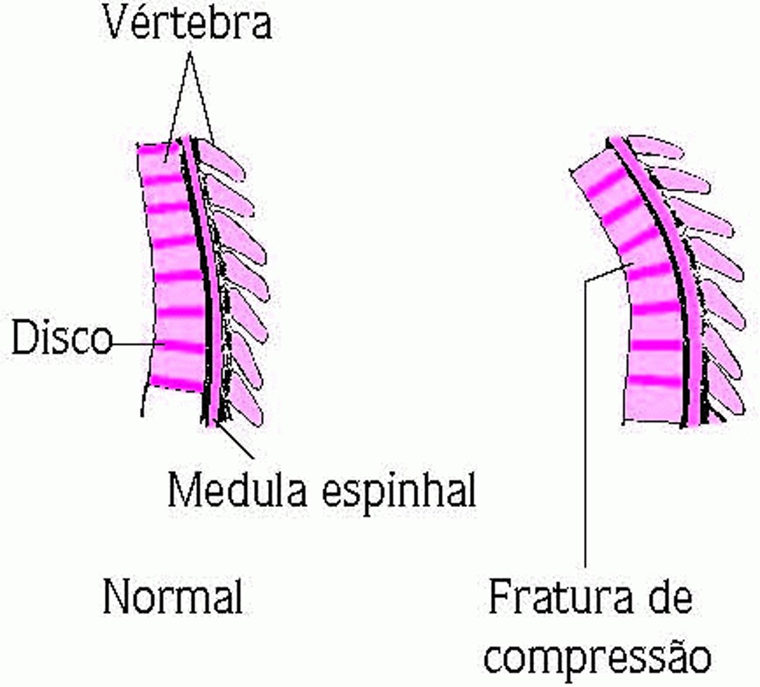 Fraturas de compressão da coluna