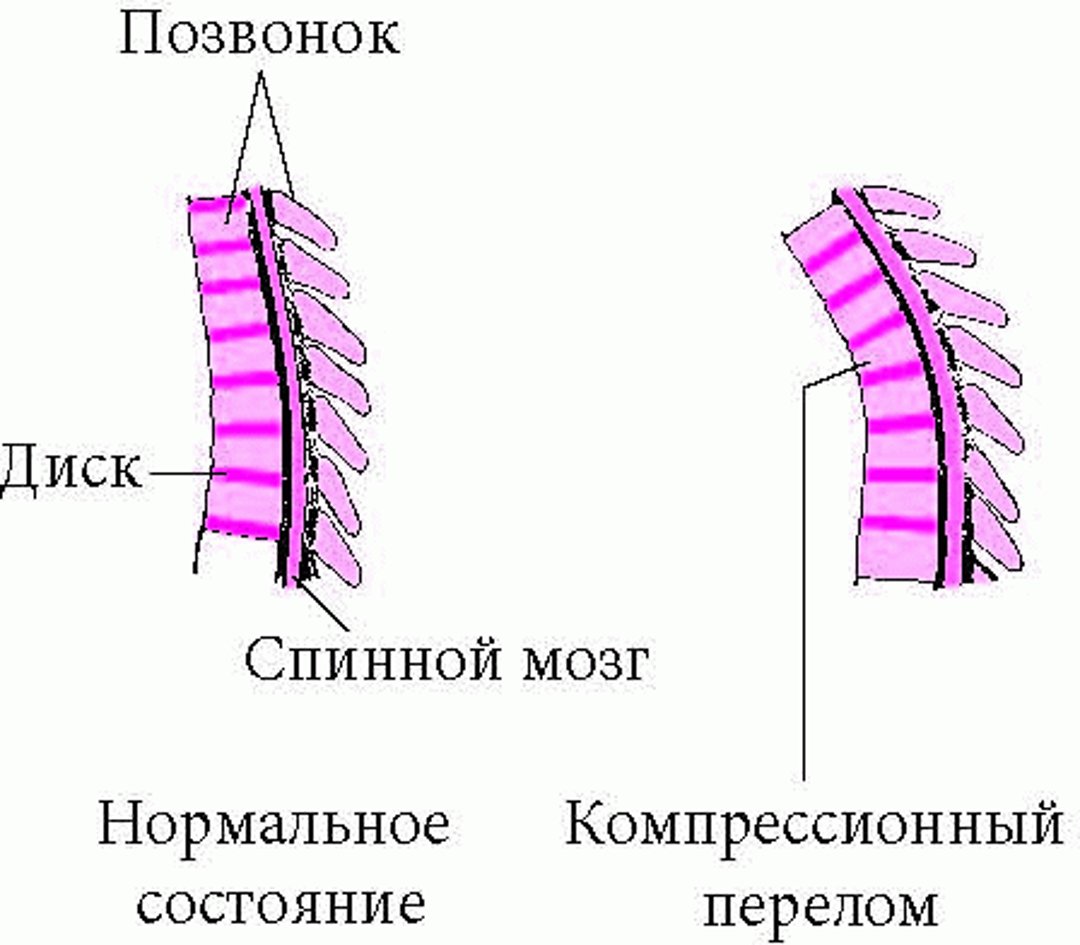 Компрессионные переломы позвоночника