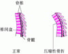 脊柱压缩性骨折