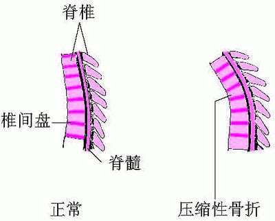 脊柱压缩性骨折
