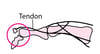 Avulsion Fracture of the Finger