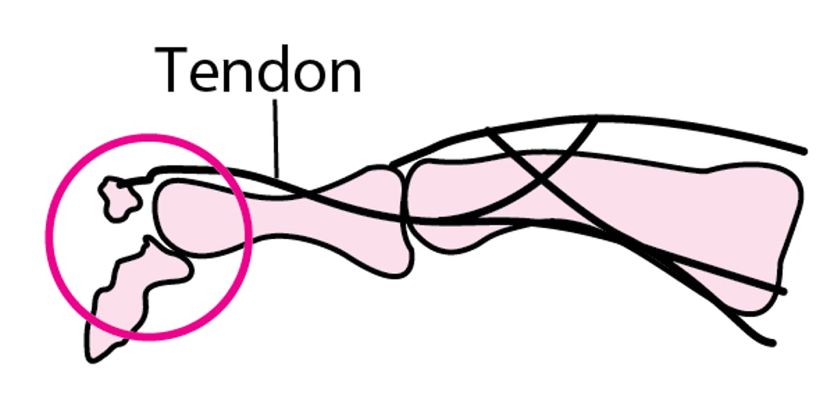 Fractura por avulsión del dedo de la mano