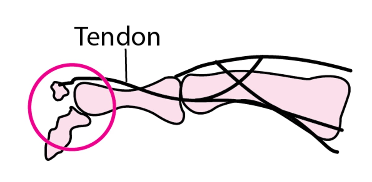 Fracture du doigt par arrachement