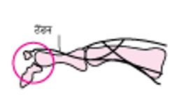 उंगली के अवल्शन फ्रैक्चर