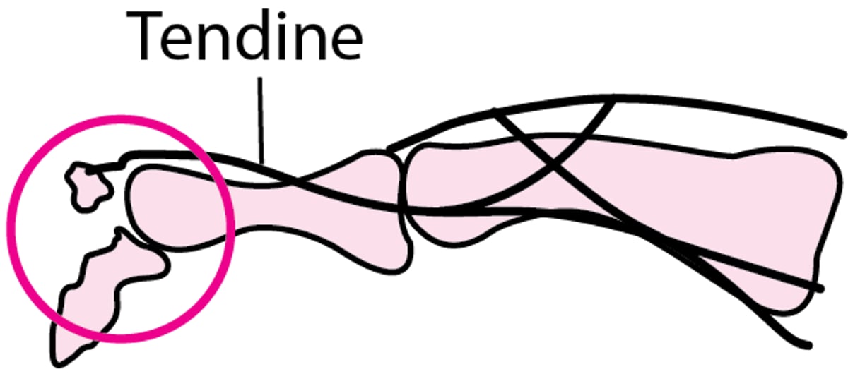 Frattura delle dita da avulsione