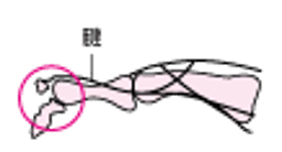 手ての指ゆびの剥離骨折はくりこっせつ