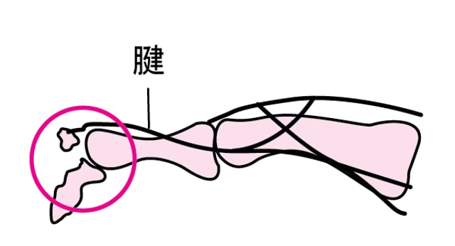 手の指の骨折 - 外傷と中毒 - MSDマニュアル家庭版