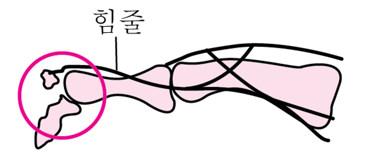 손가락 박리 골절