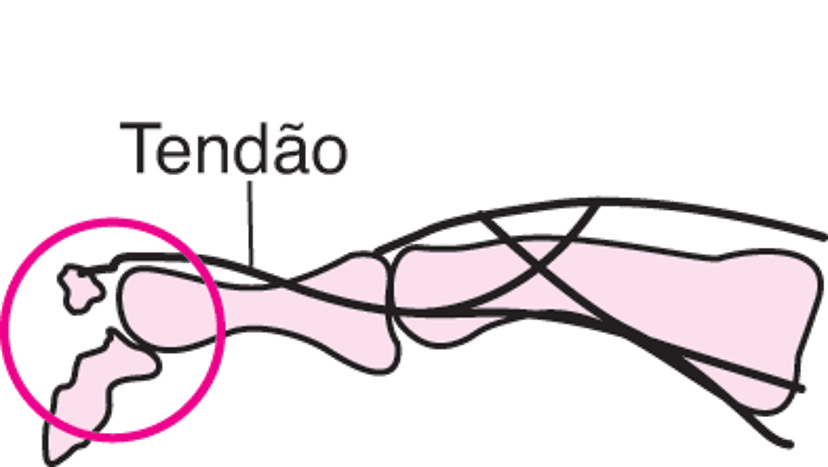 Fratura por arrancamento do dedo