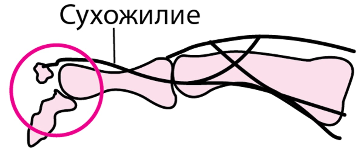 Отрывной перелом пальца