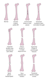 Some Types of Fractures