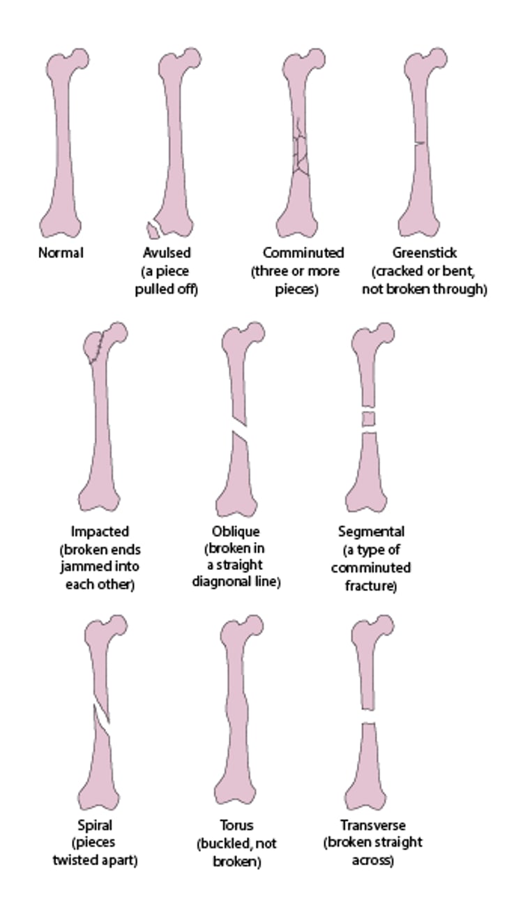 Some Types of Fractures