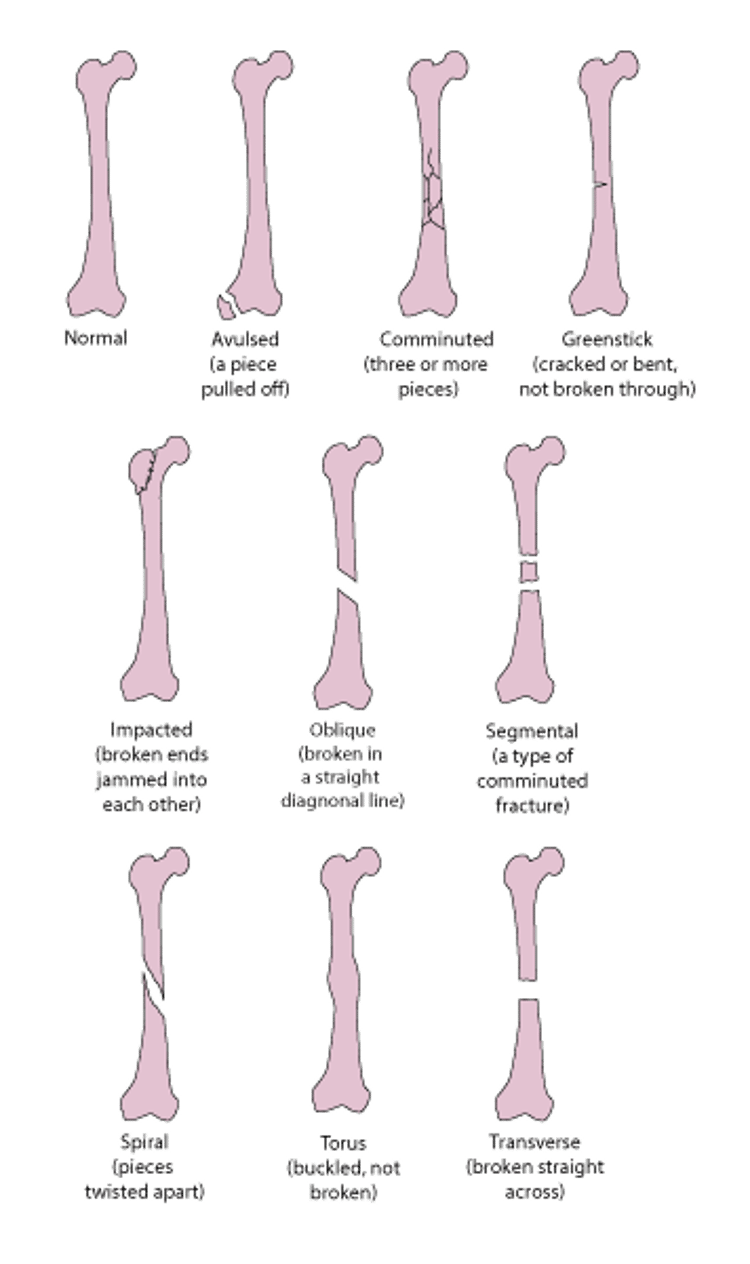 Some Types of Fractures