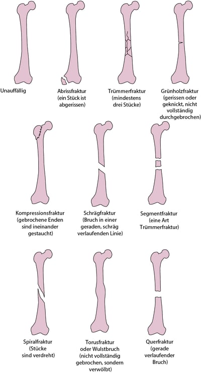 Einige Arten von Knochenbrüchen