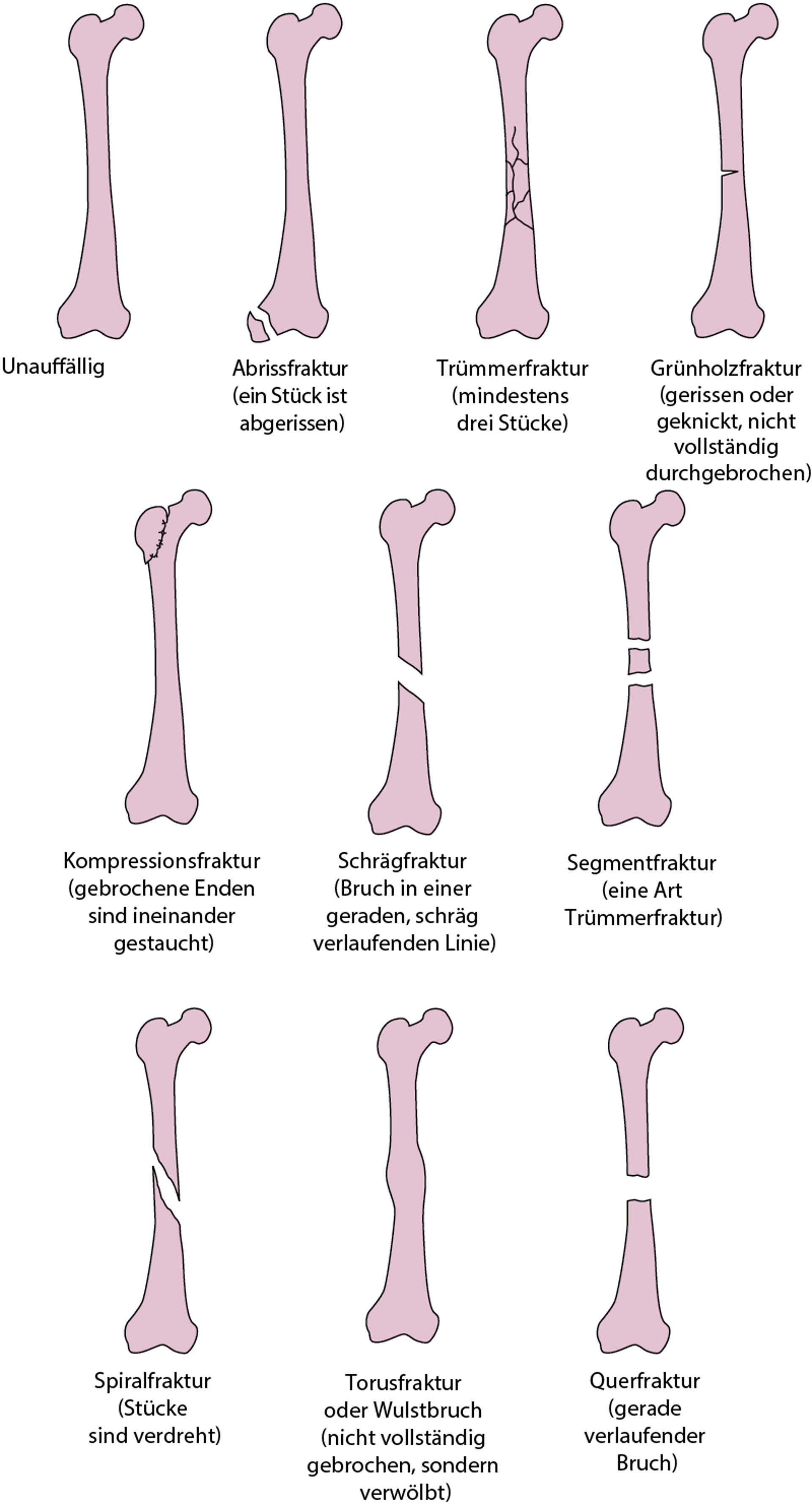 Einige Arten von Knochenbrüchen
