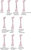 Algunos tipos de fracturas