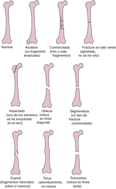 Algunos tipos de fracturas